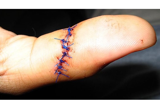 Wound stitching deals