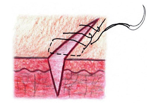 Type Of Sutures