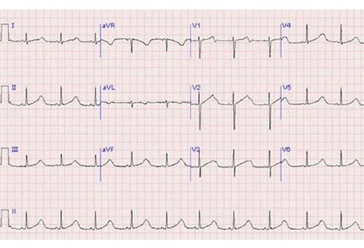 what medications cause prolonged qt syndrome