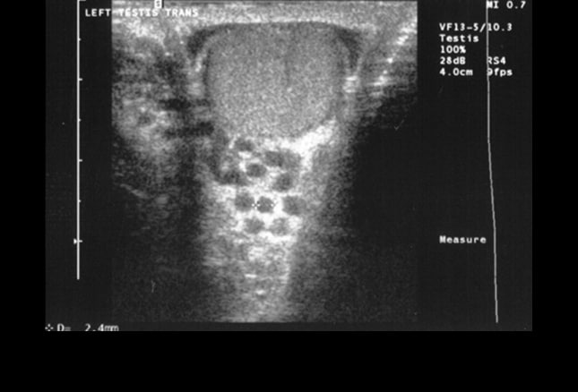 Spermatocele Location