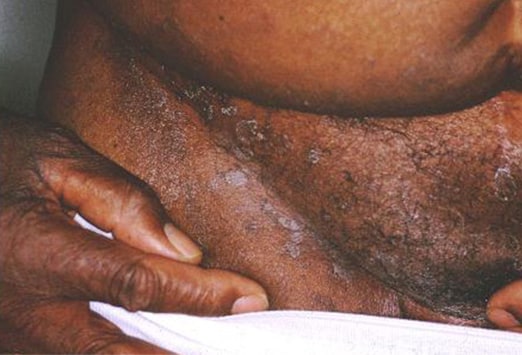 ringworm african american