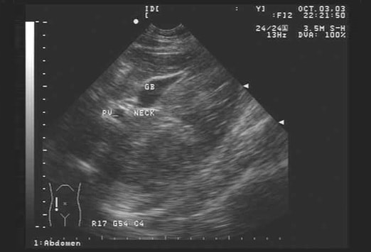 common bile duct ultrasound. The common bile duct diameter