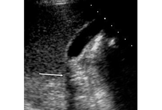 gallbladder ultrasound pictures. +gallbladder+ultrasound
