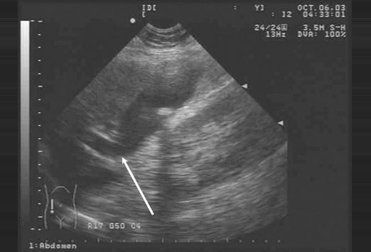 common bile duct stone. of ile duct stones