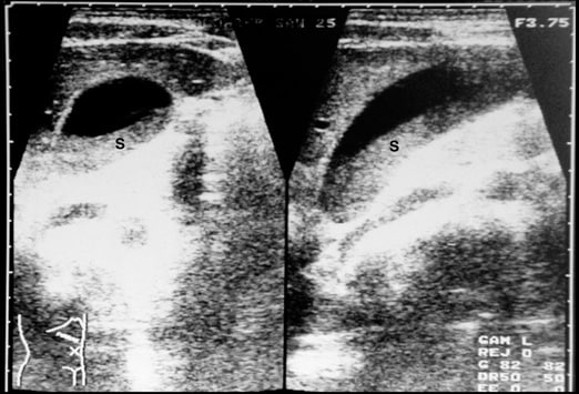 gallbladder stones ultrasound. If the gallbladder is