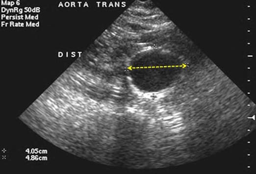 Image result for ultrasound aorta