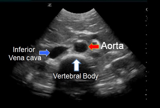 Ultrasound Assessment Of Abdominal Aortic Aneurysms