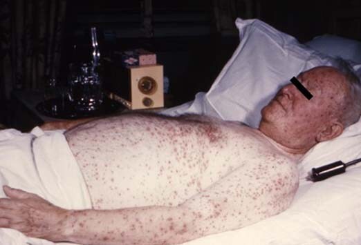 onset of chickenpox. of symptomatic onset,