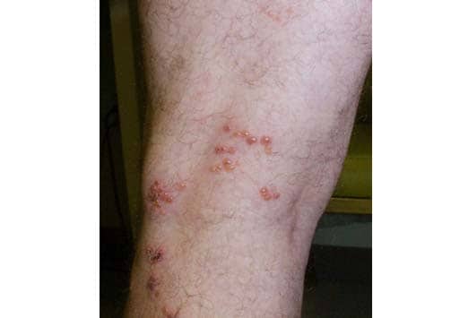 onset of chickenpox. A varicella zoster vaccine is