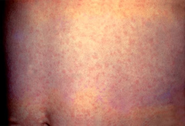 Rubella Exanthem