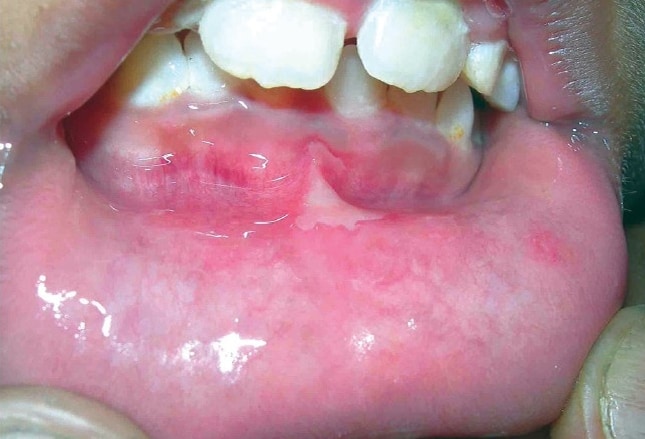 Tongue Blisters Herpes