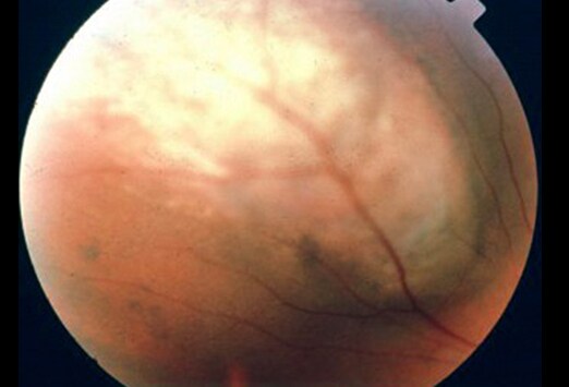 ocular tuberculosis