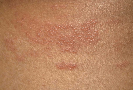 painful rash on back #11