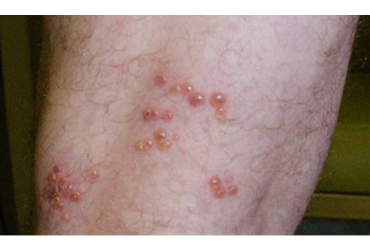 Chronic Itchy Skin Rashes in Adults: Conditions ...