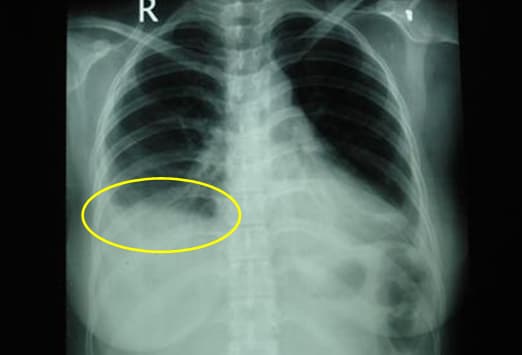 pleural effusion - definition of pleural.