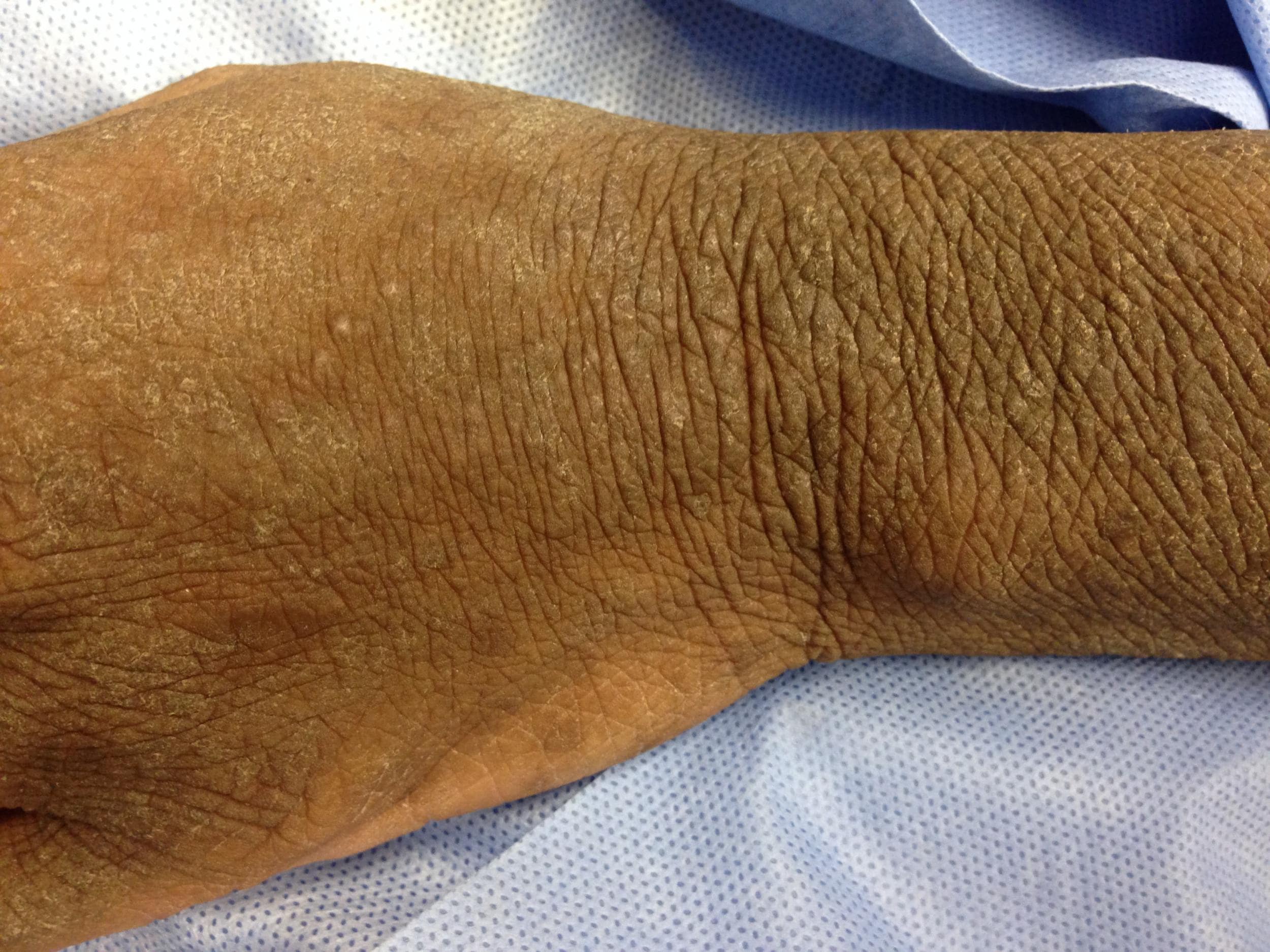 Acanthosis Nigricans Condition Treatments and Pictures