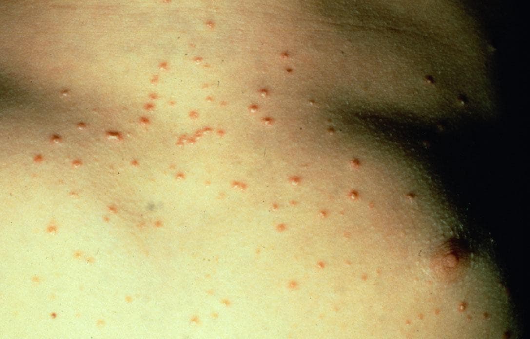 Photoclinic: Perianal Streptococcal Dermatitis ...