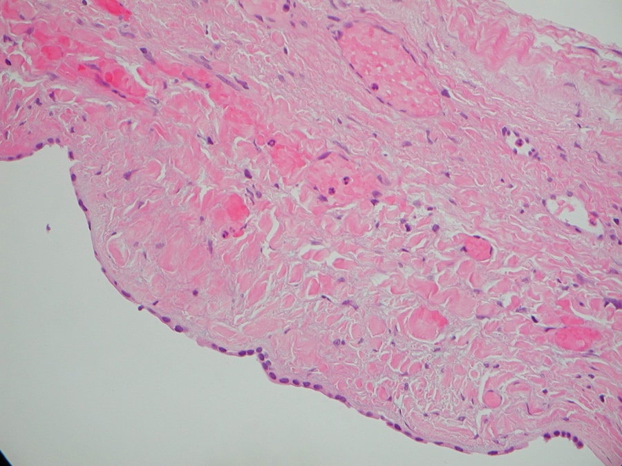 Unroofing Hepatic Cyst & Trocar Positioning