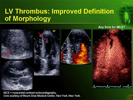 Expanding the Impact of Contrast Echocardiography