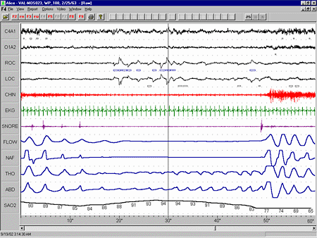 sleep apnea ambien obstructive