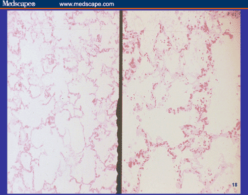 Emphysema Lung Slide