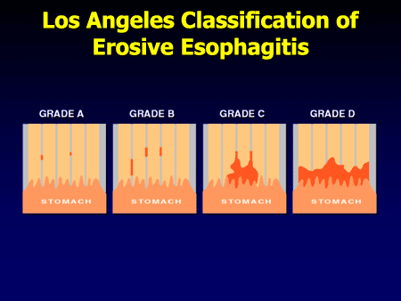 Los Angeles Classification