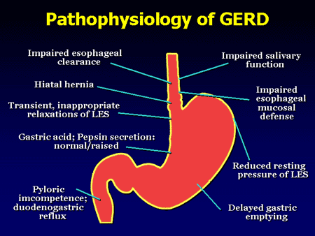  : Strategies for Coping With Gastroesophageal Reflux Disease (GERD