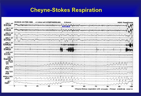 Cheyne Stoke Breathing