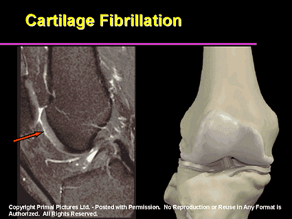 cartilage fibrillation