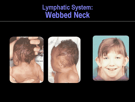 webbed neck syndrome