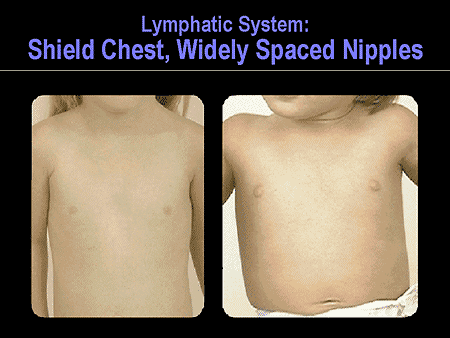 Turner Syndrome: Toward Early Recognition and Improved Outcomes