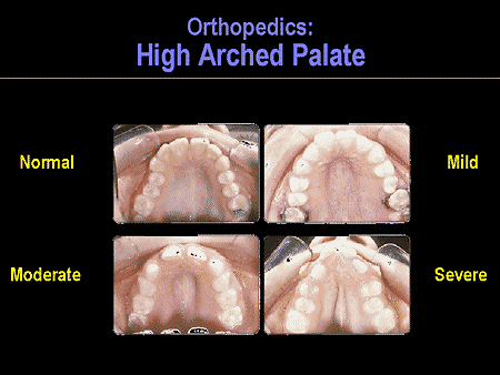 lower palate