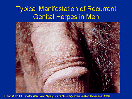 genital herpe symptoms in men