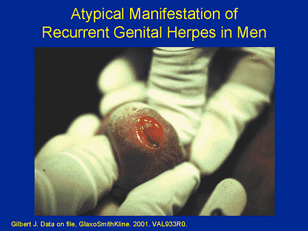 herpes pictures men. Genital Herpes in Men