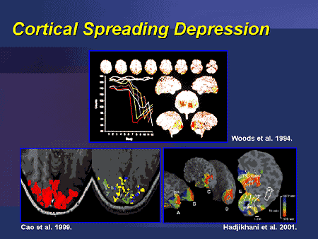 Cortical Spreading Depression