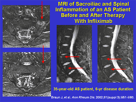 mri ankylosing spondylitis