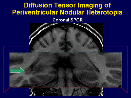 Diffusion Tensor Imaging. Diffusion Tensor Imaging of