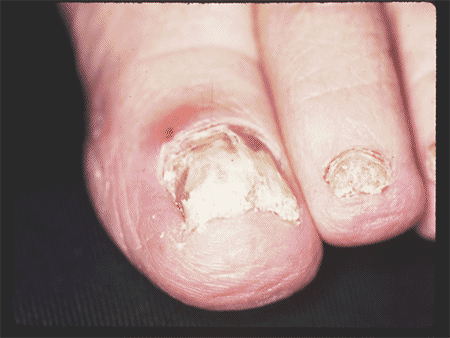 White Superficial Onychomycosis