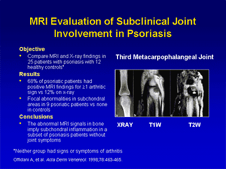 Cartoon Psoriasis