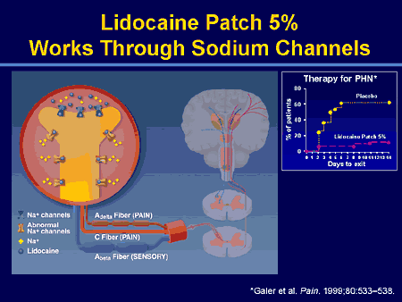 What Is Lidoderm Lidocaine Patch Used For