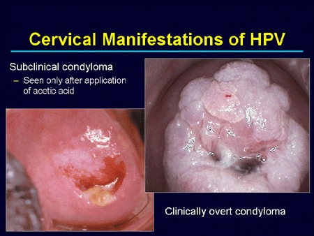 hpv on cervix