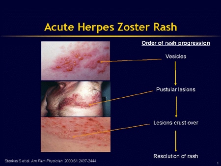 herpes zoster pictures. Herpes Zoster Rash