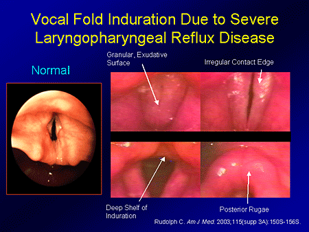 laryngopharyngeal relux