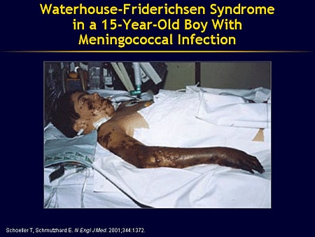Waterhouse-Friderichsen Syndrome in a 15-Year-Old Boy With Meningococcal 