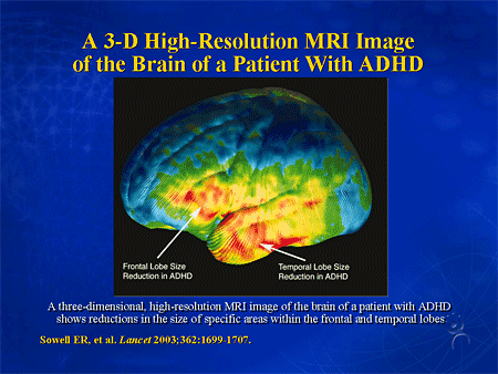 brain of adhd