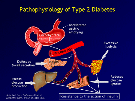 diabetes type 2 pathogenesis