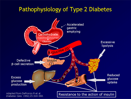 Pathophysiology | Diabetes Mellitus Type 2