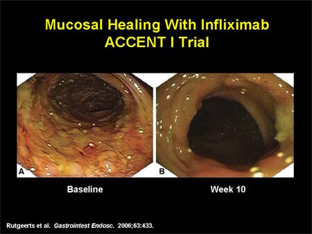 Mucosal Healing