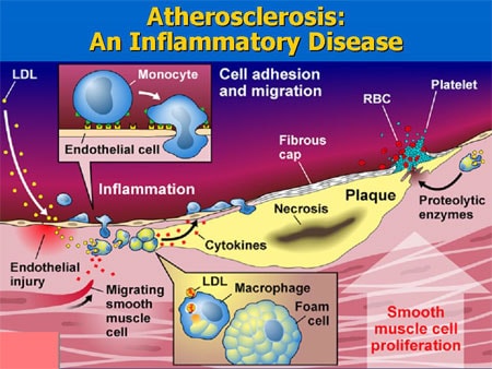 Atherosclerosis Slide