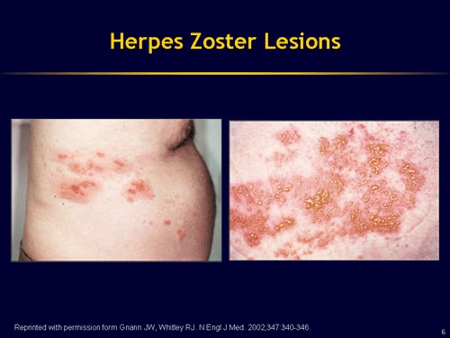 Understanding Herpes Zoster And The Herpes Zoster Vaccine (slides With 